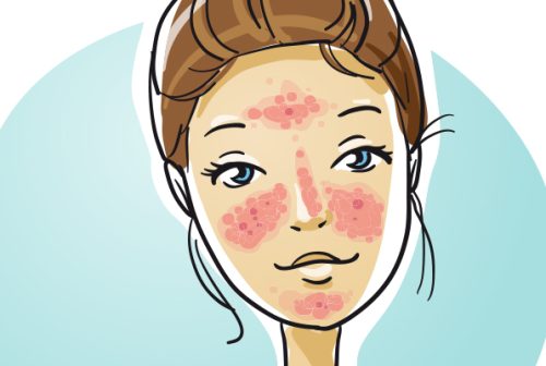 Tips on Managing Rosacea