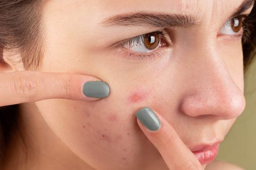 Is Laser Treatment Worth it for Acne and Scars?