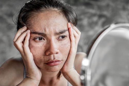 What are the causes of Melasma?