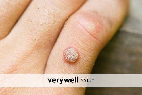 The 6 Best Wart Removers of 2022