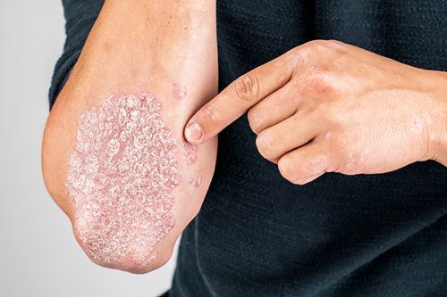 What can I do to treat my Psoriasis?