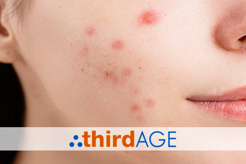 Treatment Options and Considerations for Tackling Teen Acne