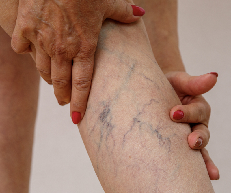 spider veins