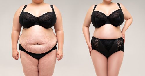What is a Mommy Makeover?