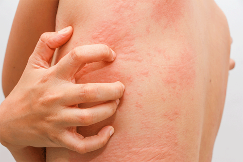 How Do I Get Rid of a Skin Allergic Reaction and Fast?