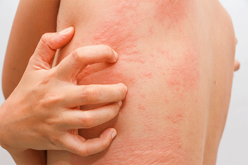 Hives, skin allergy