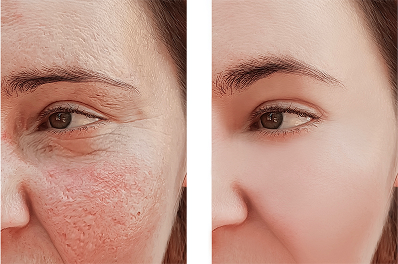 I Tried Fractional CO2 Laser Treatment, and I'm Amazed by the Results — See  Photos