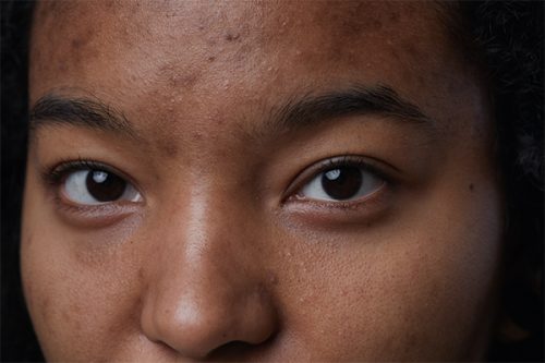 How To Get Rid of Acne Scars on African American Skin