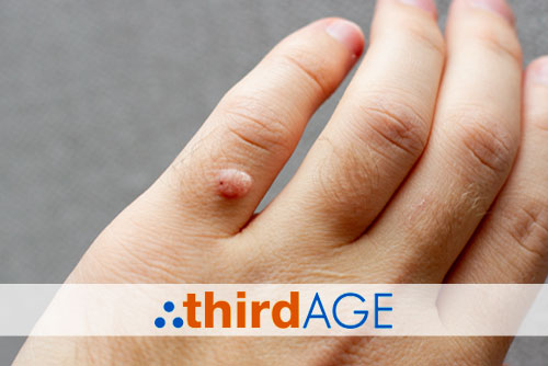 Common Types of Warts and What to Do About Them
