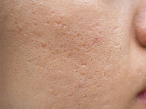 Do Chemical Peel for Acne Scars Help?