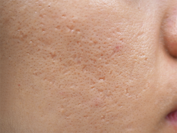 acne scarring