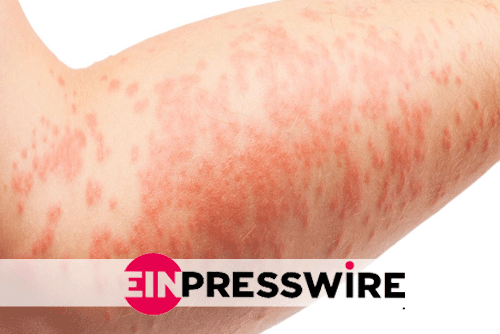 Distinguishing the differences between Psoriasis and Eczema