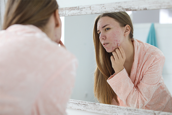 ACNE AND ECZEMA