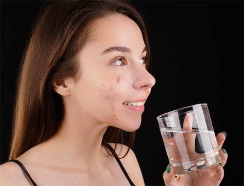 How to Stop Acne if I Have Dry Skin?