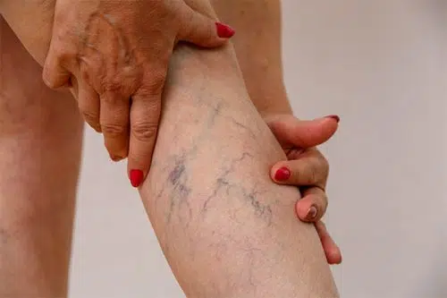 Can Spider Veins Turn Into Varicose Veins?