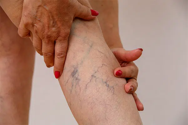 spider veins