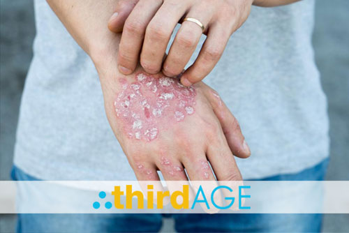 Distinguishing the Differences Between Psoriasis and Exzema
