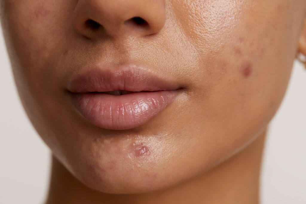 female face acne