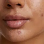 female face acne