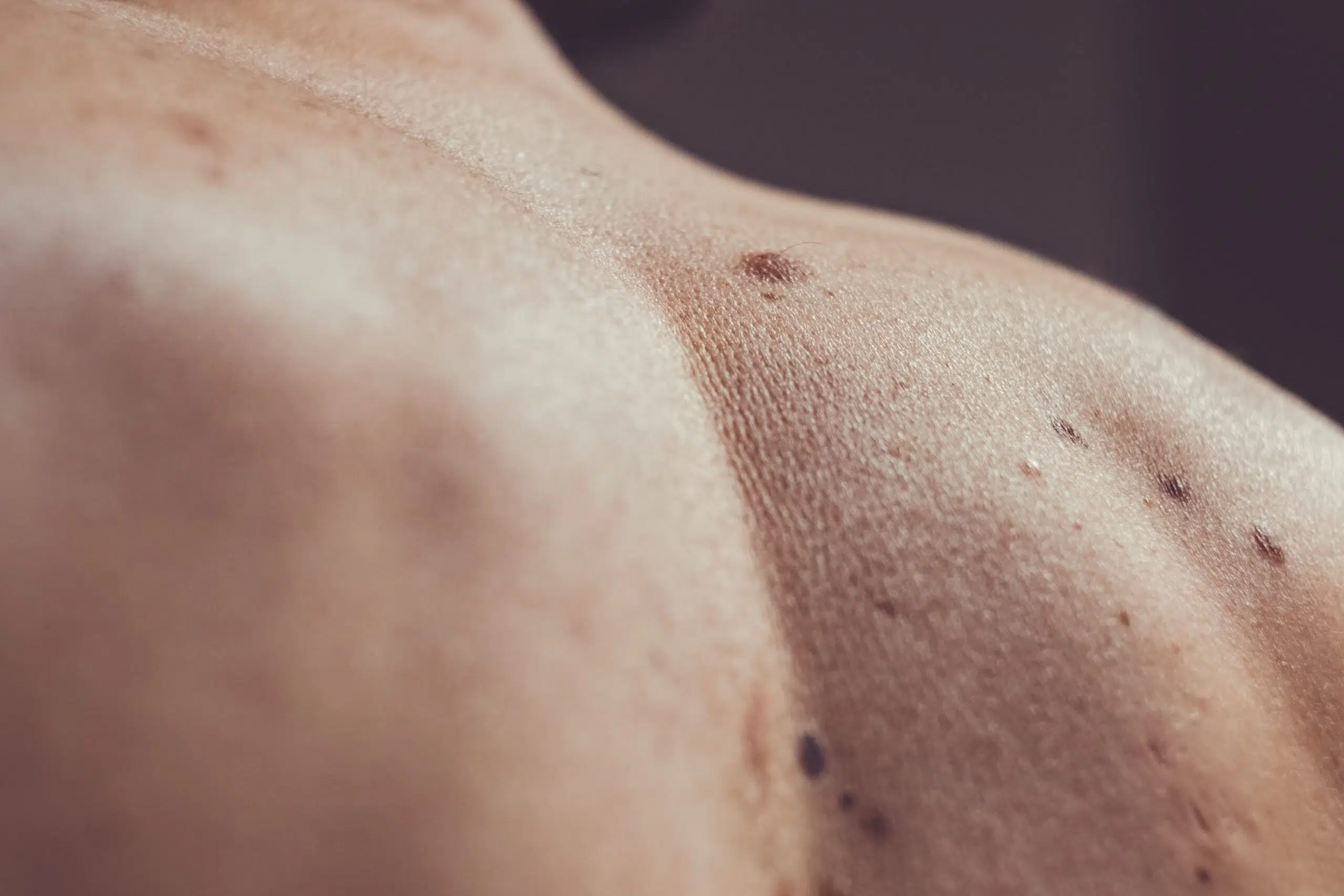 Close-up view of a melanocytic nevus (mole) on human skin, showing a dark brown, slightly raised circular lesion with defined borders.